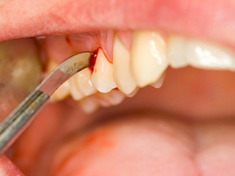 Diş eti hastalıkları ve bilinmesi gerekenler Sağlık Sever